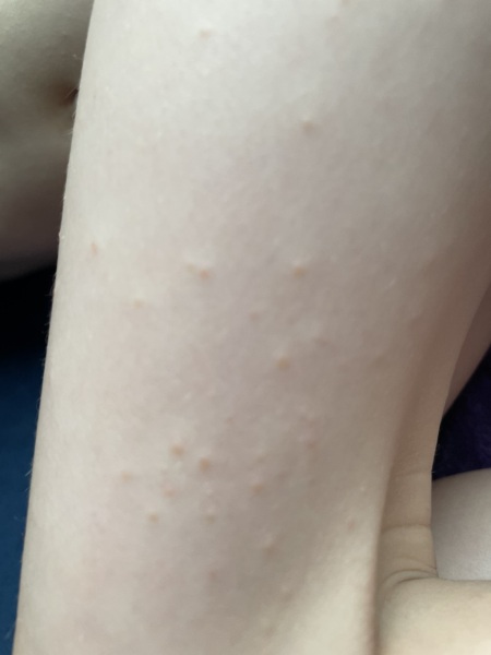 Rash/spots on 5 year old - any ideas? Waiting to phone doctor