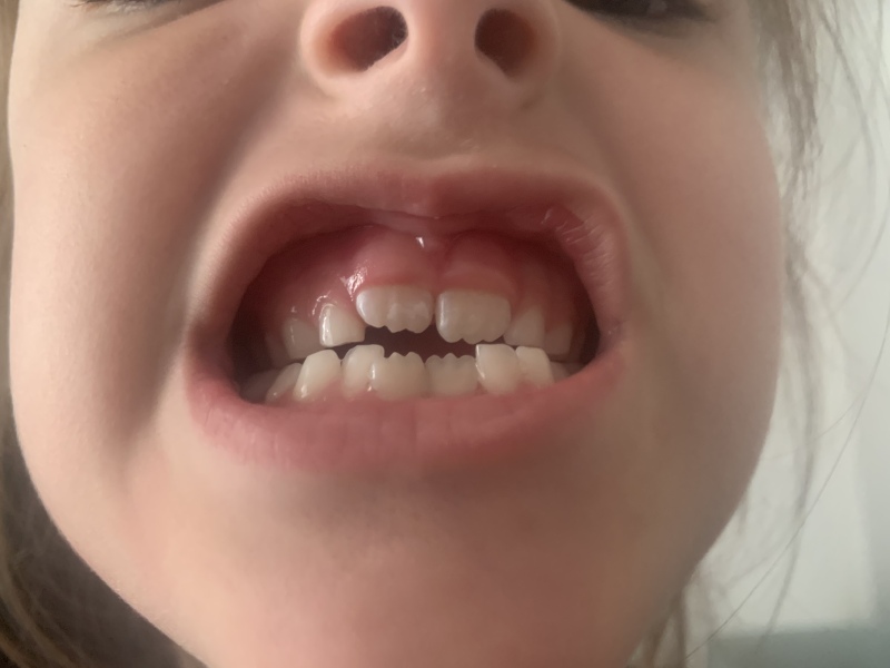 white patch on new tooth? 