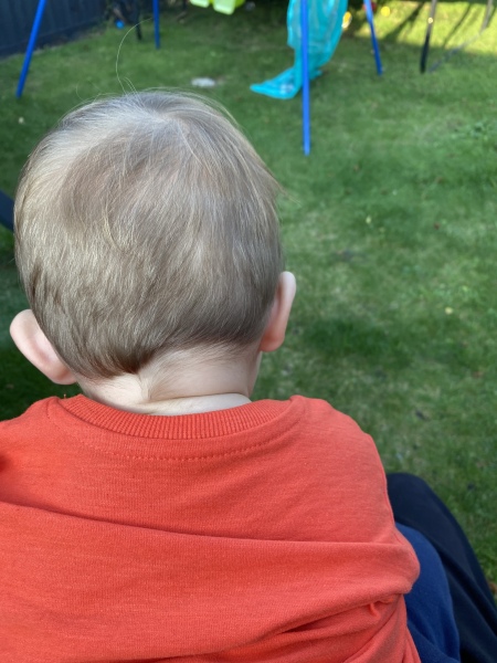 10 month old has a ‘sticky out’ ear
