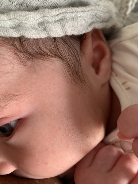 FTM to ask about baby rash