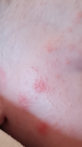 Allergy or baby acne or something else...? 
