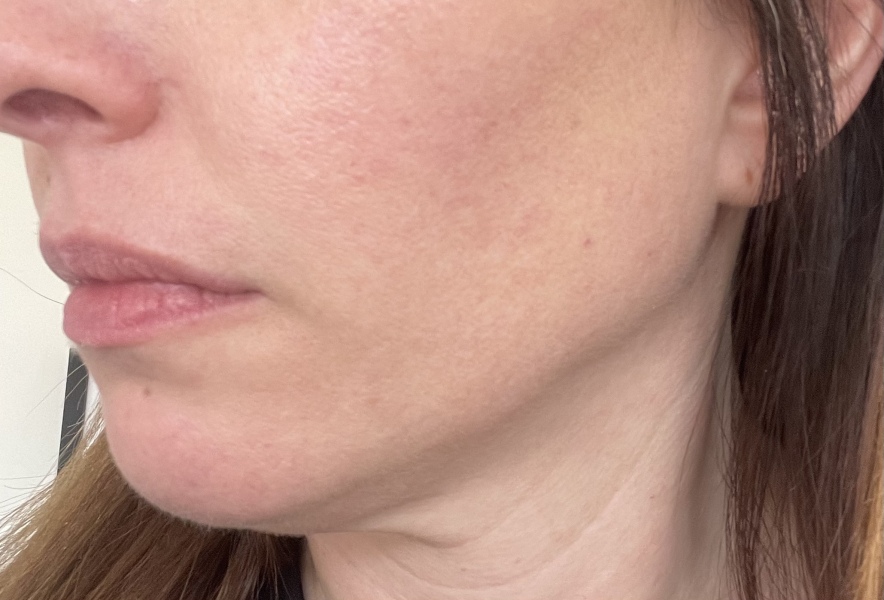 I’ve had a thread lift