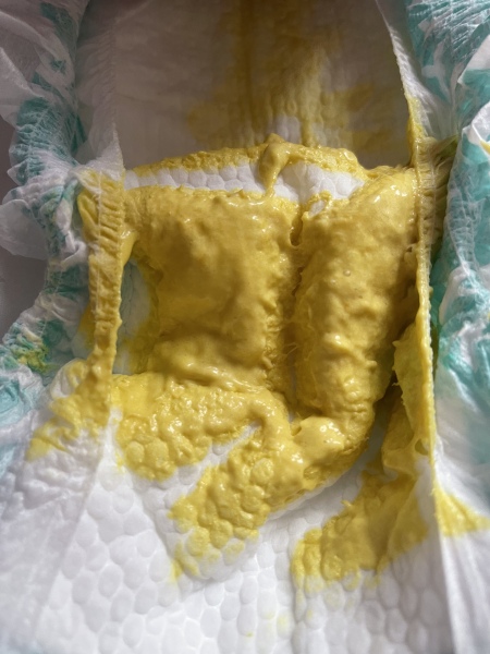 Possible CMPA rash/mucusy poo? (Pics)