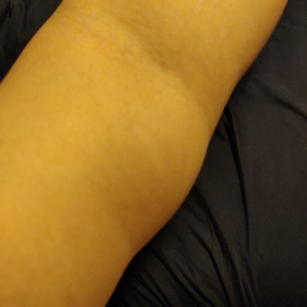 Woke up with a lump on my arm