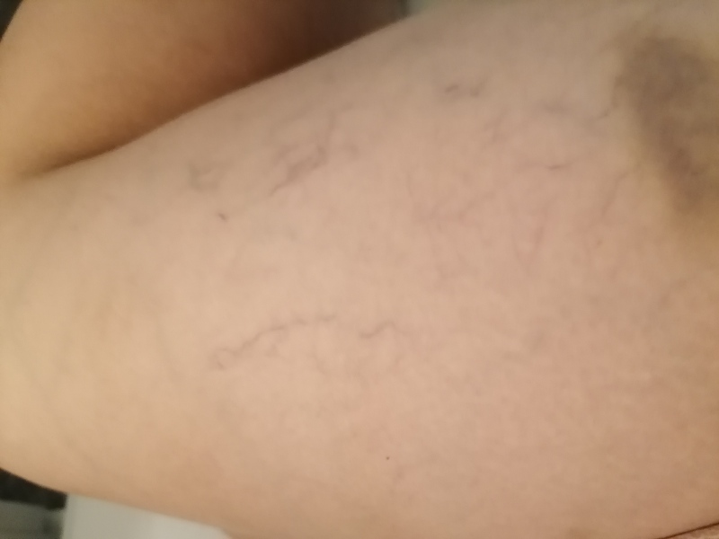 Heavy achy feeling Veiny legs 