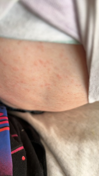 Toddler Rash