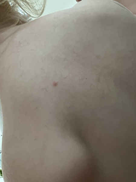 Chicken pox?