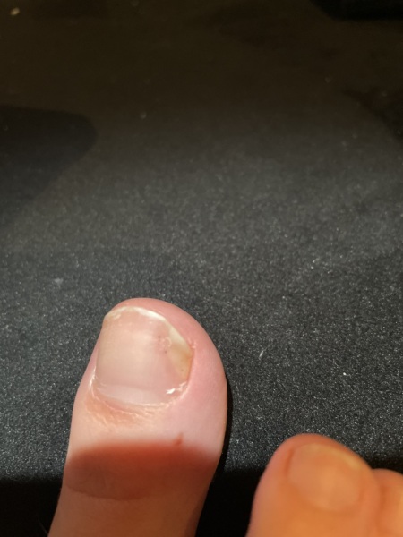 Start of fungal nail infection??