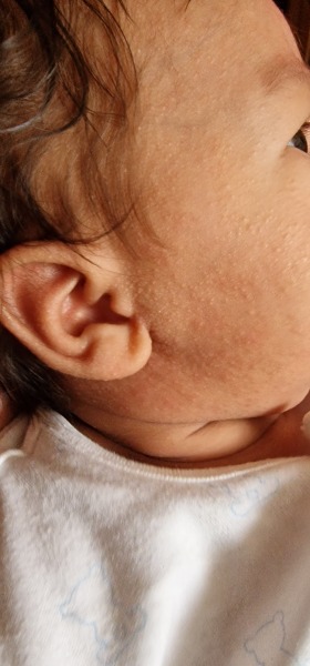 FTM... spots on baby