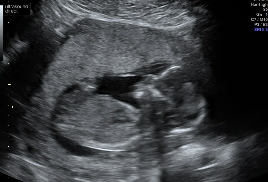 IVFers Due Mar & Apr 2023