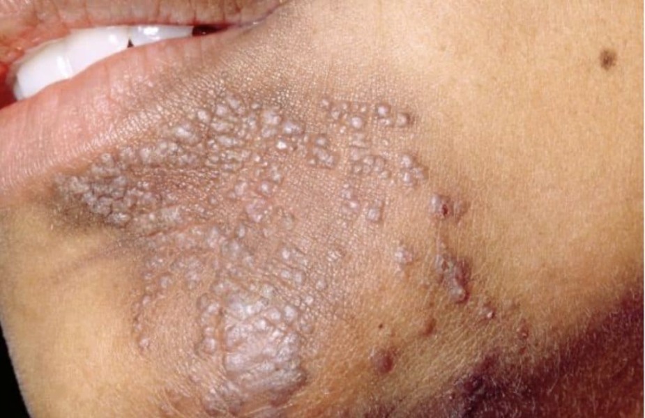 I fear becoming a walking wart.