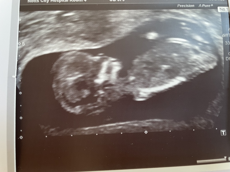 Nub/skull theory gender guesses please!