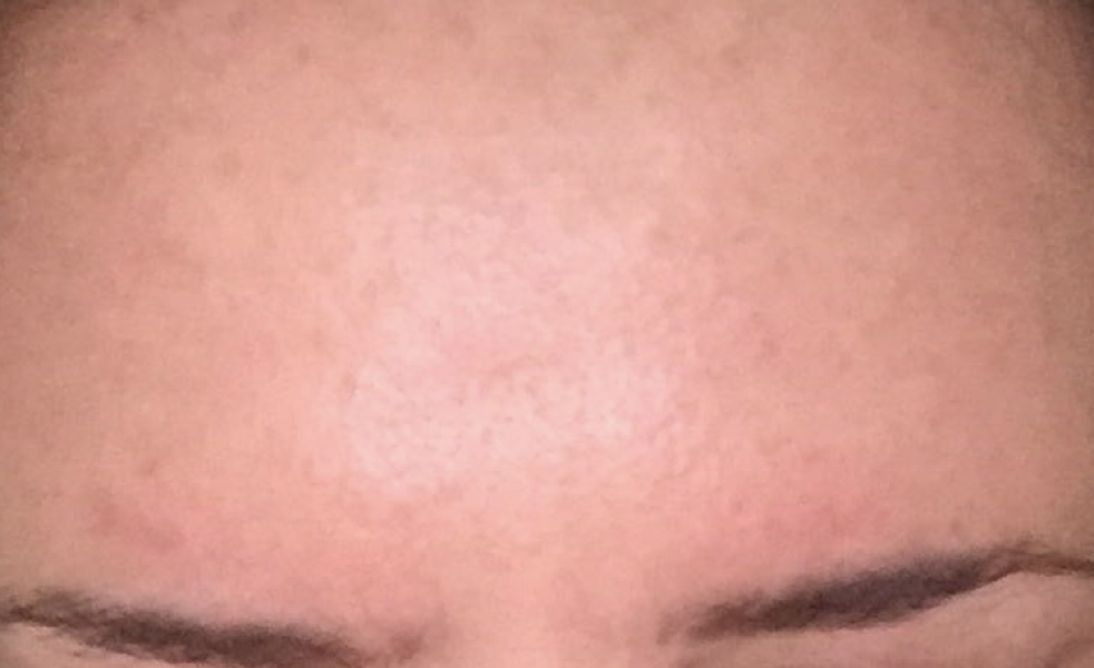 2 huge lines between brows - help