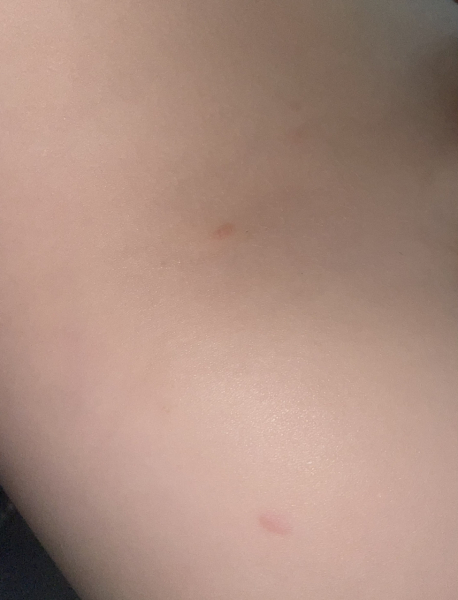Chickenpox despite vaccine?