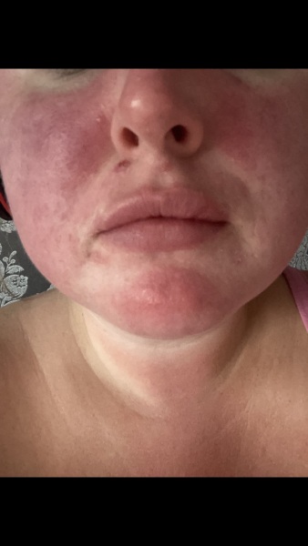 What is this rash on my face?