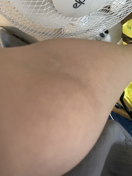 Woke up with a lump on my arm