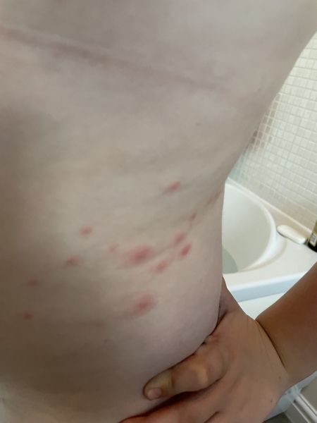 To think this is chicken pox?
