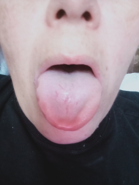 Burning mouth syndrome