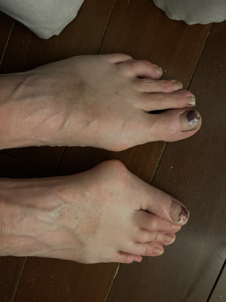 Post op bunion removal