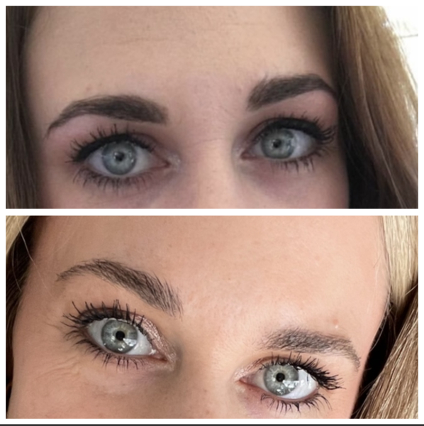 2 huge lines between brows - help