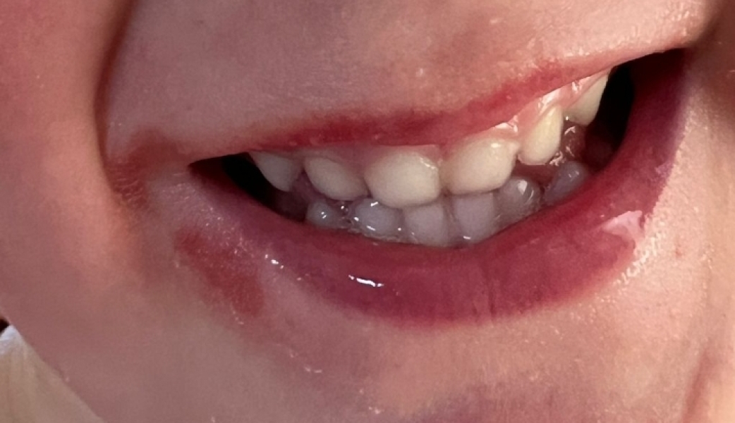Sore near mouth 
