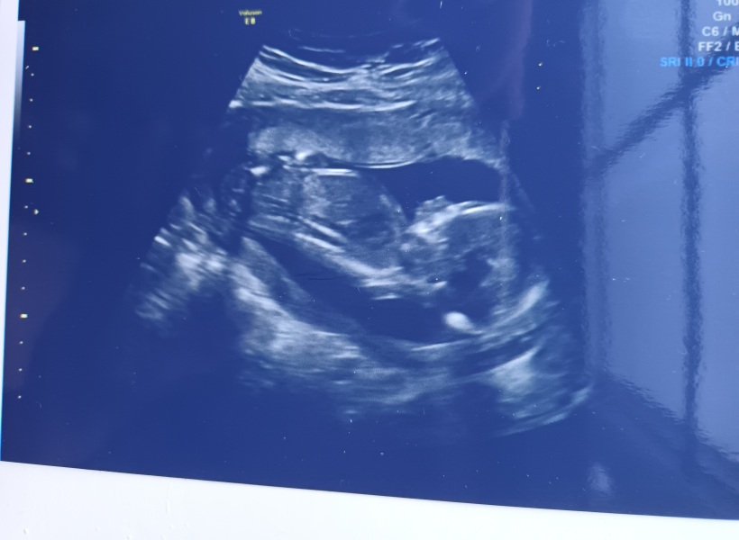 Do you know if this scan is a boy or girl? Gender scan 15 weeks