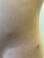 I am not convinced this is chickenpox....