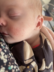 Possible CMPA rash/mucusy poo? (Pics)