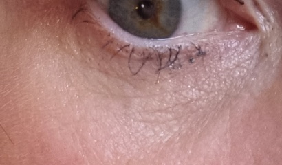 Crinkly under eye treatments