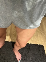 To ask about these veins?