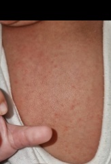 FTM .. Baby acne, heat rash or allergy??