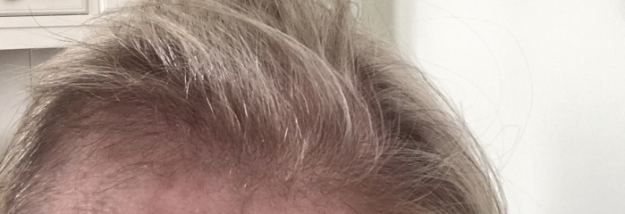 What could be causing my thinning hair?