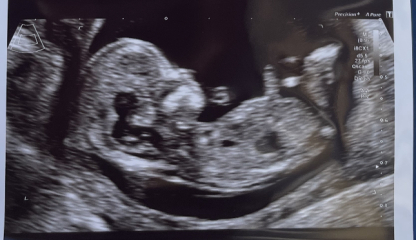 Nub guesses at 13 weeks? 