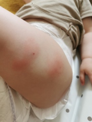 12 month jabs - sore legs