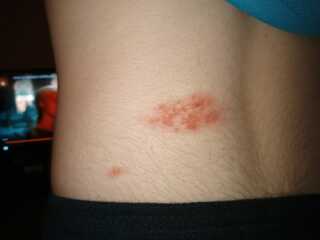Son's rash. What is it? 