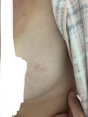 What is this rash? Pic