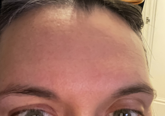 2 huge lines between brows - help
