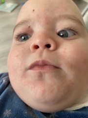 Does this look like a milk rash?