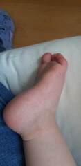 Hand, foot and mouth ?