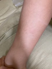 Itchy bumps and vomiting