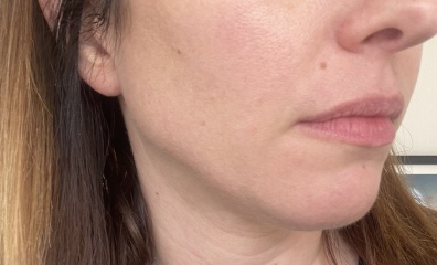 I’ve had a thread lift