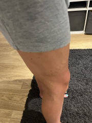 To ask about these veins?