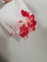 Implantation or early period? TMI PICS