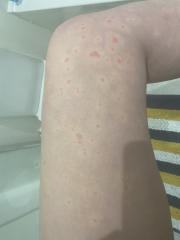 Hives all over body all of a sudden