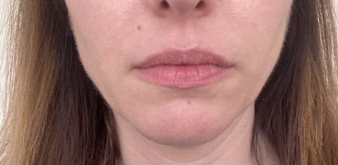 I’ve had a thread lift