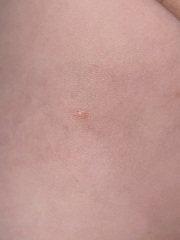 This isn't chickenpox right?