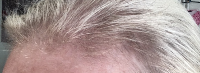 What could be causing my thinning hair?