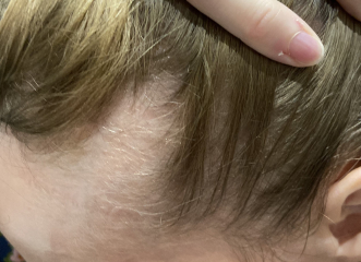 Regaine/Minoxidil users support thread