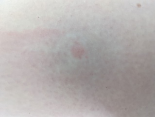To ask if these are bed bug bites?!