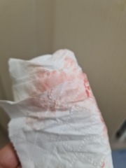 Implantation or early period? TMI PICS